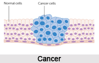 Cancer, Disease