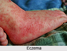 Eczema