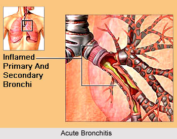 Yoga for Bronchitis, Yoga and Health