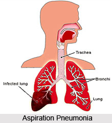 Types of Pneumonia
