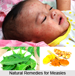 Natural Remedy for Measles, Naturopathy