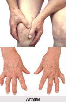 Natural Remedy for Arthritis, Indian Naturopathy