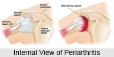 Periarthritis, Type of Arthritis