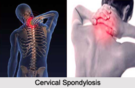 Cervical Spondylosis, Joint and Muscle Ailments
