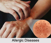 Allergic Diseases, Naturopathy