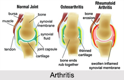 Arthritis, Bone Ailment