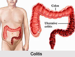Colitis, Naturopathy