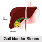 Gall Bladder Stones, Naturopathy
