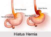 Hiatus Hernia, Stomach Ailment