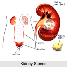 Kidney Stones, Kidney Disorder