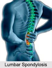 Lumbar Spondylosis, Joint and Muscle Ailment