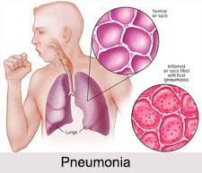 Pneumonia, Chest Ailment