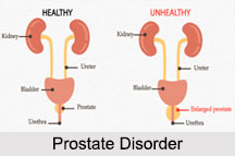 Prostate Disorder, Male Disorder