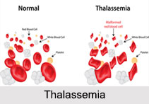 Thalassemia, Blood Related Ailment