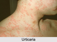Urticaria, Allergic Disease