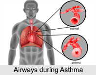 Asthma, Allergic Disease