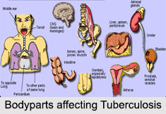 Tuberculosis, Chest Ailment