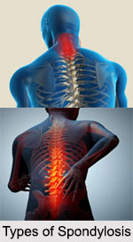 Spondylosis, Joint and Muscle Ailment