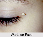 Warts, Skin Disorder