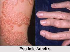 Types of Arthritis, Bone Ailment
