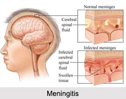 Meningitis, Infectious Disease