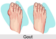 Gout, Bone Ailment