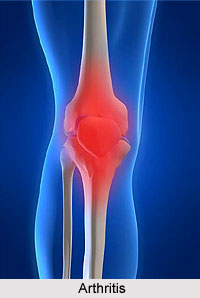 Causes of Joint Muscle Ailments