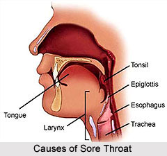 Causes of Sore Throat or Pharyngitis