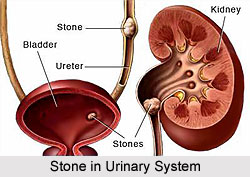 Stone in Urinary Disorders