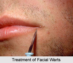 Treatments of Warts