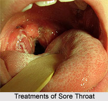 Treatments of Sore Throat or Pharyngitis