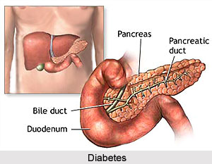Types of Diabetes Mellitus