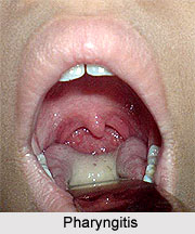 Types of Sore Throat or Pharyngitis