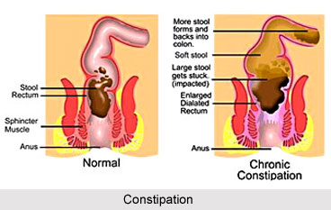 Yoga for Constipation, Yoga and Health