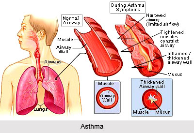 Yoga and Asthma