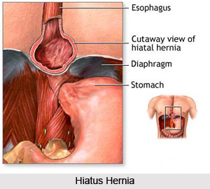 Treatment of Hiatus hernia