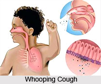 Types of Cough