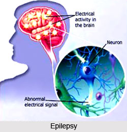 Causes of Epilepsy