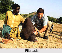 Filariasis or Shlipada Jwara