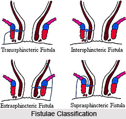 Types of Fistulas