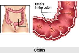 Symptoms of Colitis