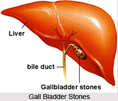 Causes of Gall Bladder Stones