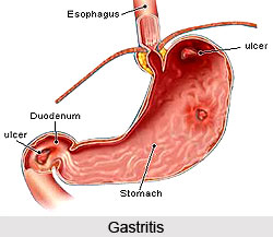 Causes for Gastritis