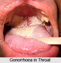 Gonorrhoea or Ushnavata