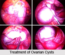Treatment of Ovarian Tumors And Cysts