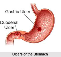 Ulcers of the Stomach or Grahani