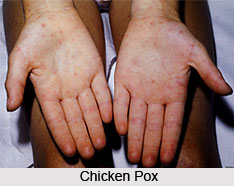 History of Chicken Pox