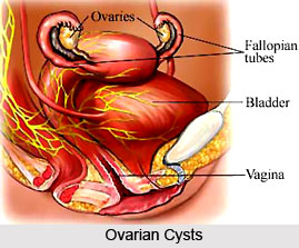 Symptoms of Ovarian Tumors And Cysts