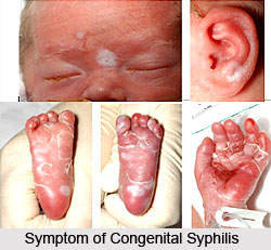 Syphilis or Firanga