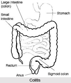 Causes of Colitis